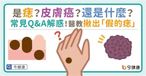 痣的形成原因|是痣？皮膚癌？還是什麼？常見Q&A解惑！醫教揪出「。